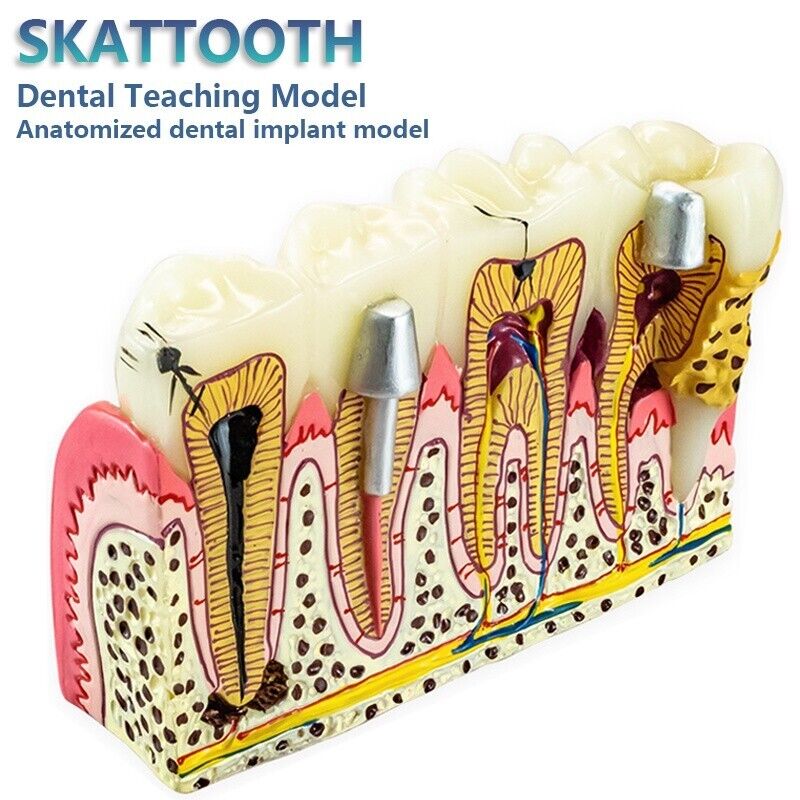 Dental Diseased Teeth and Gums Model Caries Anatomical Pathological Model