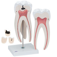 3B Scientific Giant Molar with Dental Cavities Human Tooth Models 6 Part Dentist picture