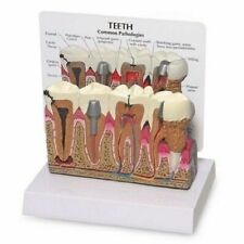 Dental Diseased Teeth and Gums Model Patient Education Teaching Model US STOCK picture