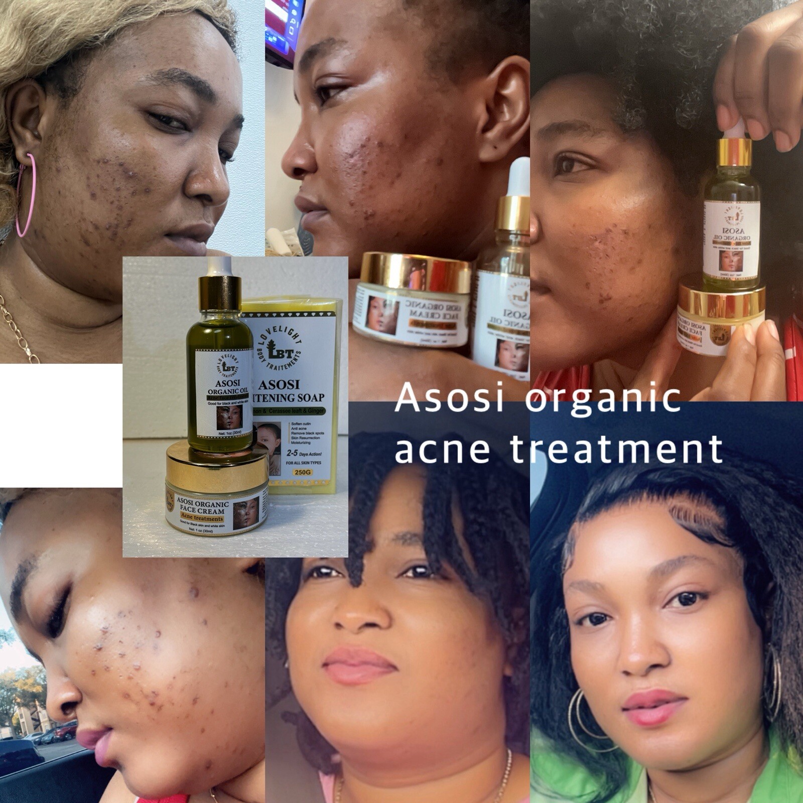 Asosi Organic Acne Treatment 3 Pieces. Oil Soap Cream Asosi Organic Acne Treatment 3 Pieces. Oil Soap Cream