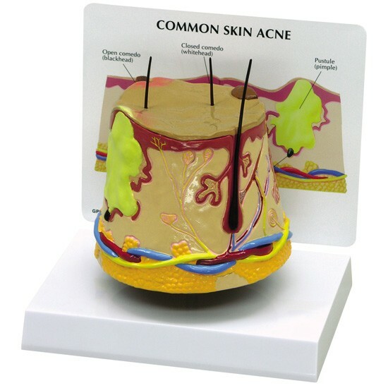 Skin Acne Anatomical Model  GPI  LFA #3750 See VIDEO Make Us an Offer