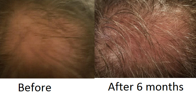5 Classic Hair Follicle and Adipose Serums for the price of 4 1 FREE 5 ships