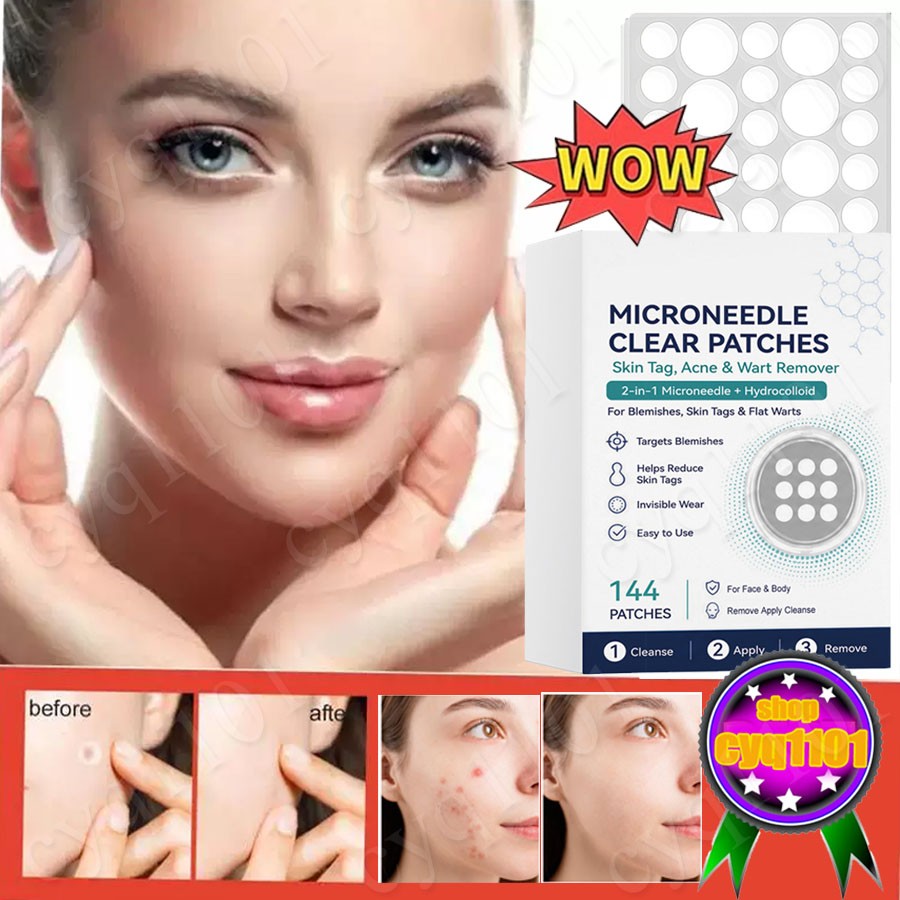 Curalona Microneedle Patches 144pcs, Skin Tag Wart Acne Remover Patches ~US