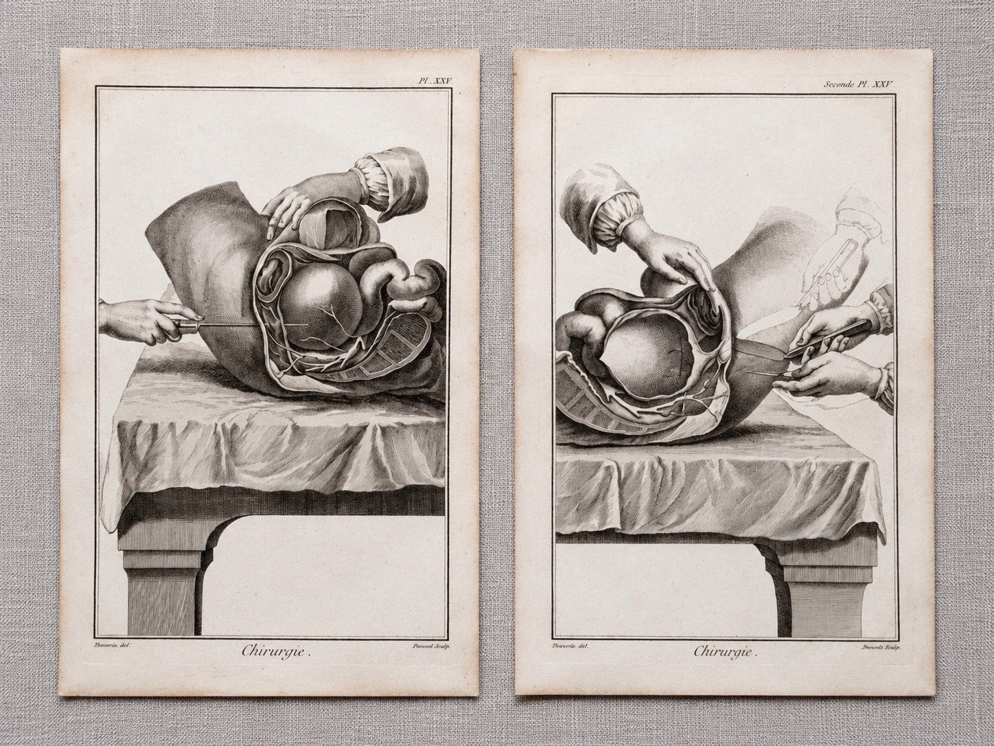 Pair 18thC Diderot Encyclopandie Surgical Engravings Chirurgie Medical Plates