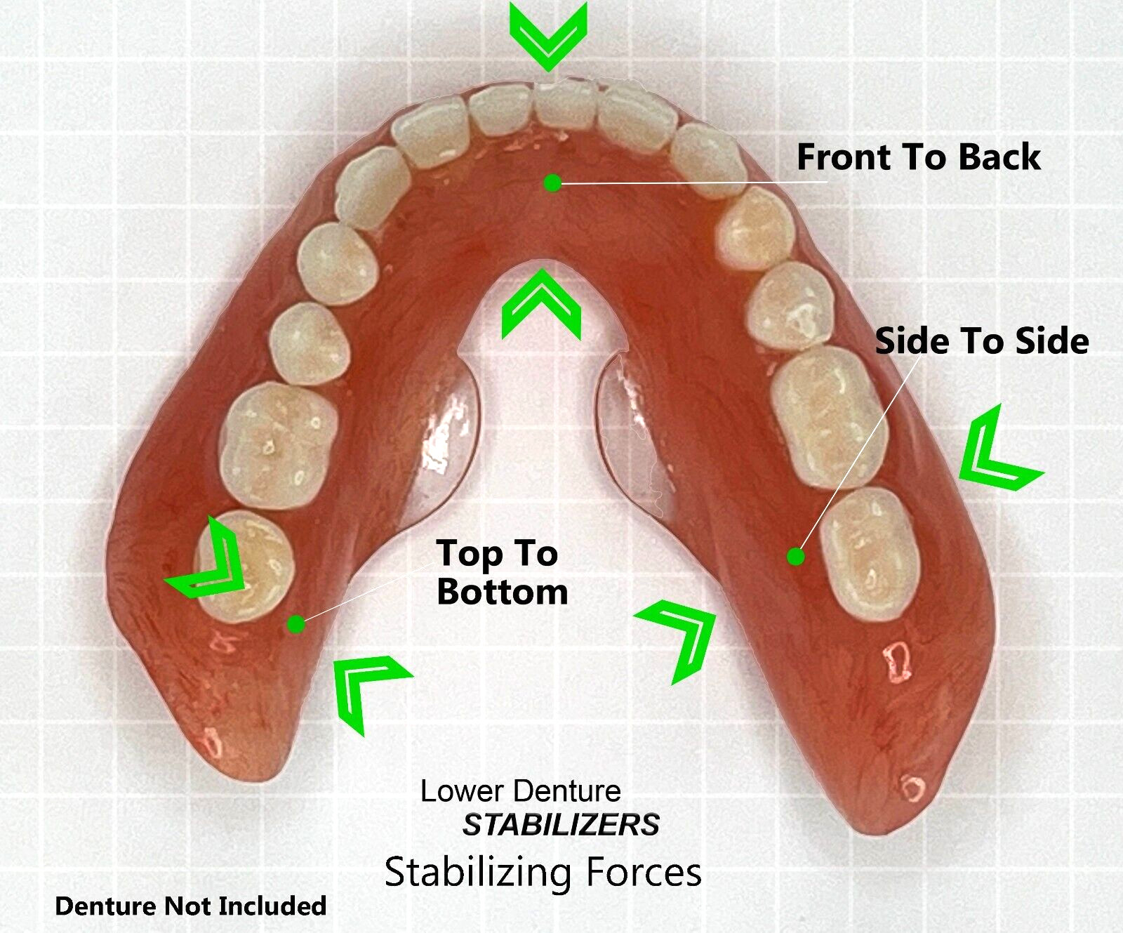 Lower Denture Stabilizers DIY Kit-Affordable Denture Stabilization Lower Denture Stabilizers DIY Kit-Affordable Denture Stabilization