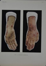 Antique Anatomy Art Print Medical Human Disease Halloween Original 1914 picture