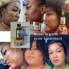 Asosi Organic Acne Treatment 3 Pieces.  Oil Soap Cream picture
