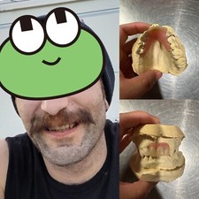 CUSTOM MISSING TEETH FLIPPER/ StayPlate for Upper Lower  (Hard Acrylic MATERIAL) picture