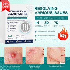 Curalona Microneedle Patches 144pcs, Skin Tag Wart Acne Remover Patches ~20% OFF picture