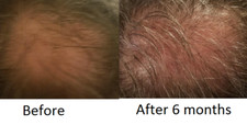 5 Classic Hair Follicle and Adipose Serums for the price of 4 1 FREE 5 ships picture