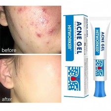 Salicylic Acid Acne Cream – Pimple Spot Treatment, Oil Control & Pore Care picture