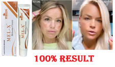 Wheezal Mel-X melasma Cream  for skin pigmentation like melasma, chloasma  (25g) picture